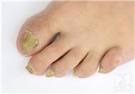 引起患者患有灰指甲的原因都有哪些