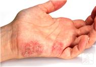 汗疱性湿疹为常见疾病，治疗方法有哪些？