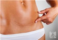 卵巢囊肿切除术术后的四个护理方法