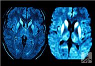 可逆性后部脑病综合征的定义以及临床表现