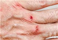 烧伤疤痕需要正确护理 如何让皮肤获新生？