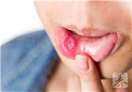 口舌生疮怎么办 治疗口舌生疮的偏方有哪些