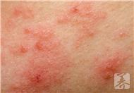 关于异位性湿疹，这些你真的都知道吗？