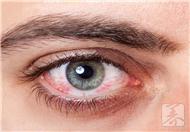 急性角膜炎会传染吗?症状表现有哪些