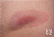 皮肤结节性红斑的症状有哪些？治疗小偏方是什么？