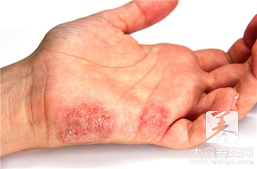 手部湿疹治疗方法：