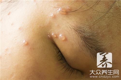(一)典型水痘的症状