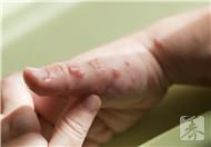脂溢性皮炎和头皮糠疹有什么区别