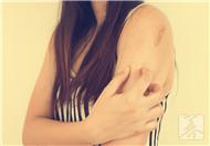 皮肤瘙痒的症状有哪些？护理方法有哪些？