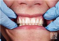牙周炎和牙龈炎区别，治疗牙周炎的方法