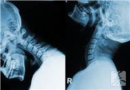 颈椎腰椎病的防治与调理方法有哪些？能好吗？
