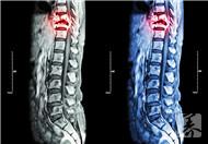 强直性脊柱炎是通过什么来诊断的