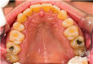 牙菌斑怎么形成的?三大阶段你须知