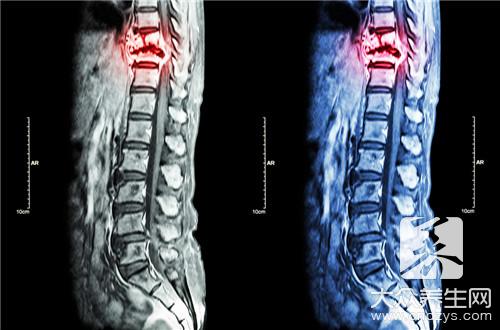 强直性脊柱炎诊断与治疗选择