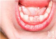 磨牙有什么危害?当心引发牙周炎