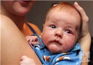 婴儿湿疹症状常见有3种，家长要注意