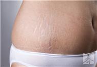 疤痕妊娠的最佳治疗期，早期发现需清宫