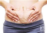孕中期出现妊娠纹还很痒怎么办？
