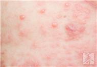 寒冷性荨麻疹是怎么引起的?症状表现有哪些