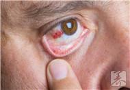 眼睛红血丝是怎么回事?当心与三因素有关