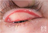 结膜和角膜的区别是什么？结膜炎如何治疗？