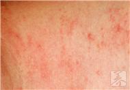 天皰疹的常見症狀有哪些？