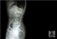 脊椎骨刺的治療方法有哪些?