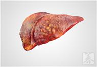 肝炎病人怕吃油腻食物的原因是什么呢？