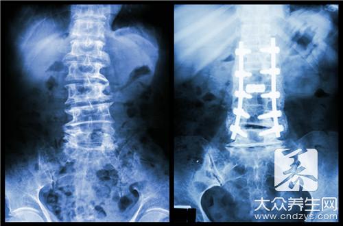 脊椎骨弯曲怎么办呢？