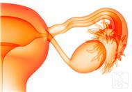 子宫积液是怎么引起的？