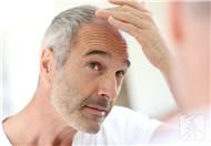 男性脱发等级多吗？如何治疗呢？
