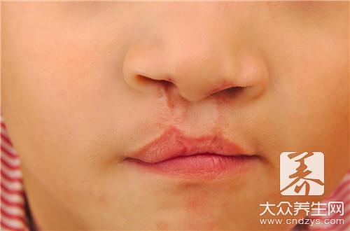 唇腭裂是怎么造成的，四大因素诱发这种现象