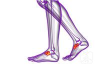 髌骨骨折弯腿技巧有哪些？髌骨骨折治疗方法及后遗症