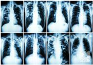 矽肺性肺纖維化帶有哪些症狀？