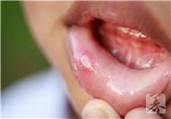 口腔粘膜囊肿的危害，口腔粘膜囊肿的治疗