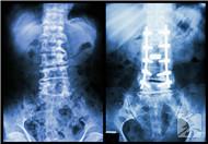 脊髓肿瘤的早期7大症状