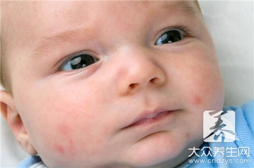 婴儿母乳性湿疹图片