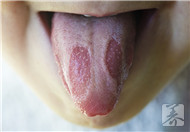 男人舌头变大是什么原因造成的