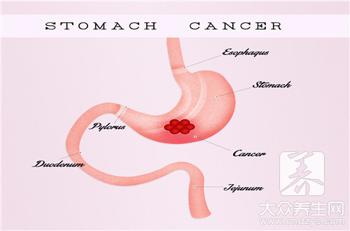 胃癌晚期能治好吗