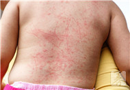 皮肤痒挠后皮下出血是什么原因？