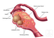 多囊卵巢綜合征患者如何改善生活方式？三個重點必須要注意