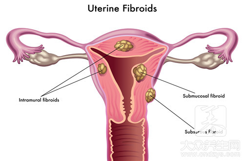 得子宫肌瘤是什么原因
