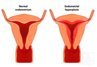 4种症状需警惕子宫内膜癌，子宫内膜癌的发生与哪些因素有关？