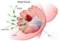 乳房纤维瘤不能吃什么