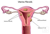 子宮內膜息肉和子宮肌瘤的區別