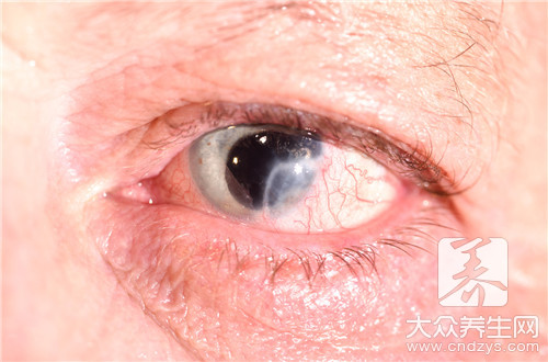  眼睑缘炎能用红霉素吗