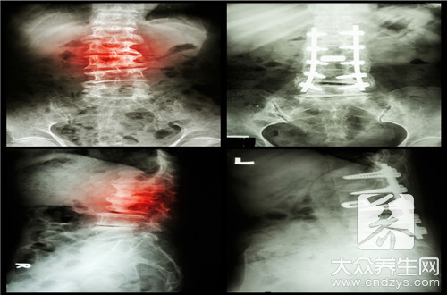  脊柱關節炎的早期症狀