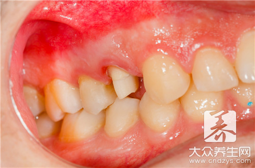 亚急性根尖周炎和急性牙髓炎的辨别