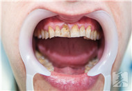 四环素牙怎么能变白？