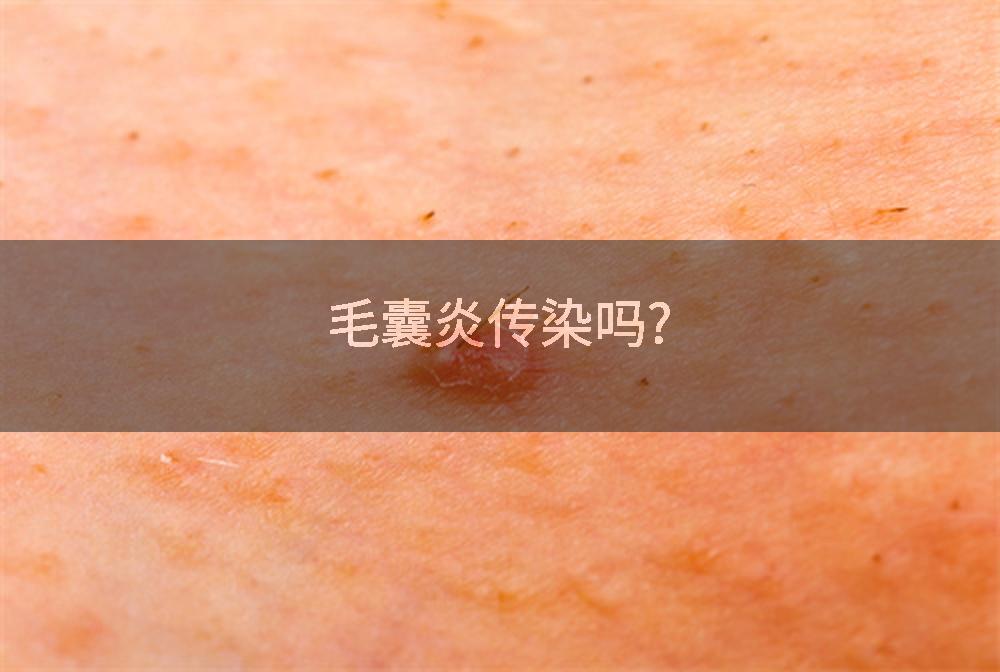 毛囊炎传染吗?